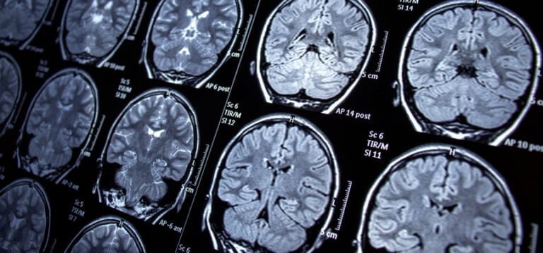 Neurocirujano abre nuevos caminos en Hartford HealthCare con un procedimiento para controlar las convulsiones