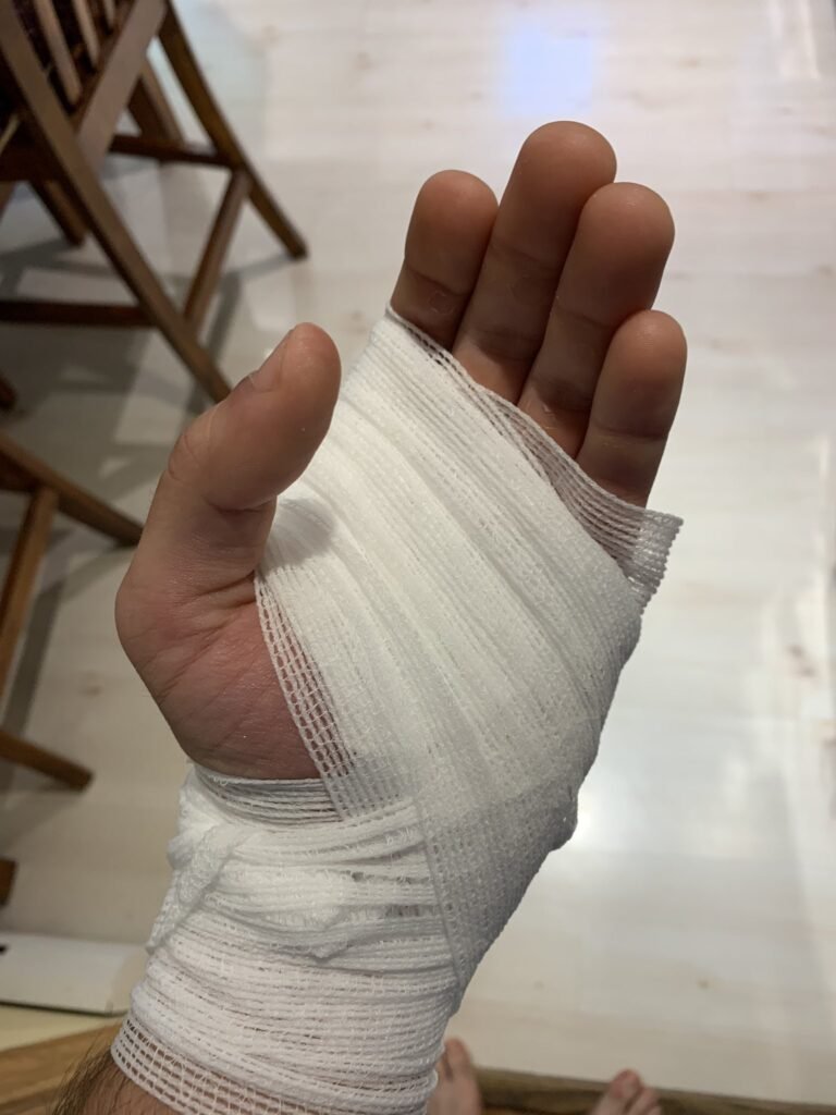 Hombre se lastima gravemente la mano mientras usaba fuegos artificiales