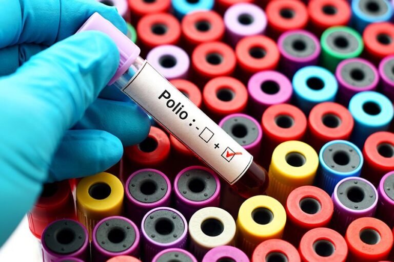 Caso de poliomielitis en NY alarma a autoridades de salud de CT