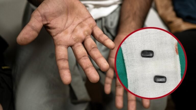 Un hombre se implantó imanes en los dedos para hacer trampa jugando a los dados