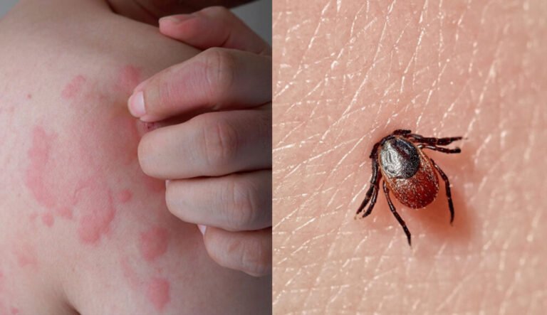 Enfermedad transmitida por garrapatas causa alergia a la carne roja, advierte agencia federal  